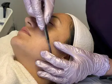 Dermaplaning single session – Belissima Clinic Dublin - 4