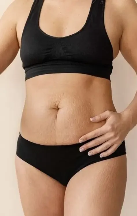 Stretch Mark Treatment - Belissima Clinic Dublin - 3