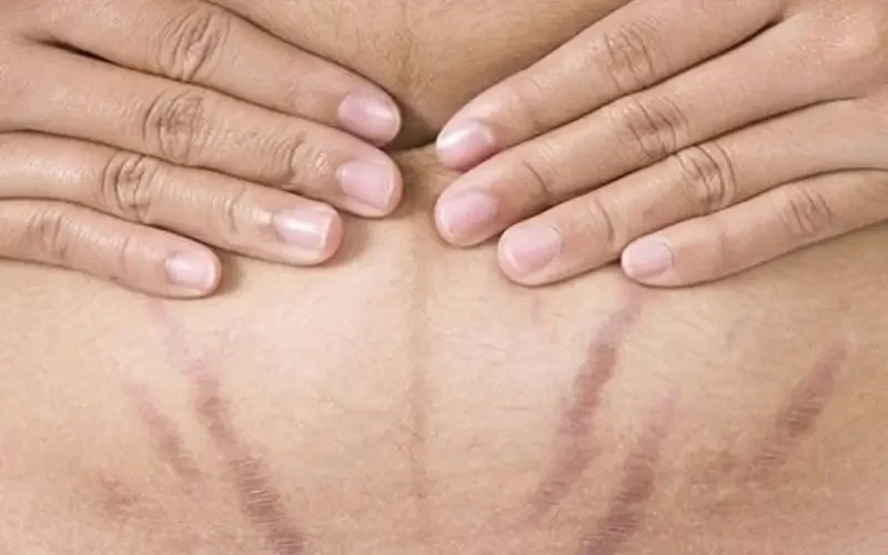 Stretch Mark Treatment - Belissima Clinic Dublin - 4